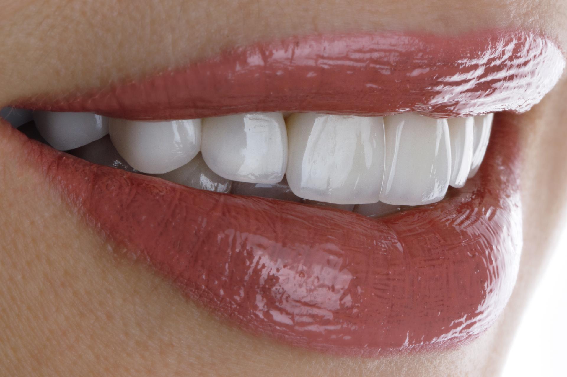 Λαμπερό Χαμόγελο με Θήκες Πορσελάνης: Επανακτήστε τη Λάμψη των Δοντιών σας