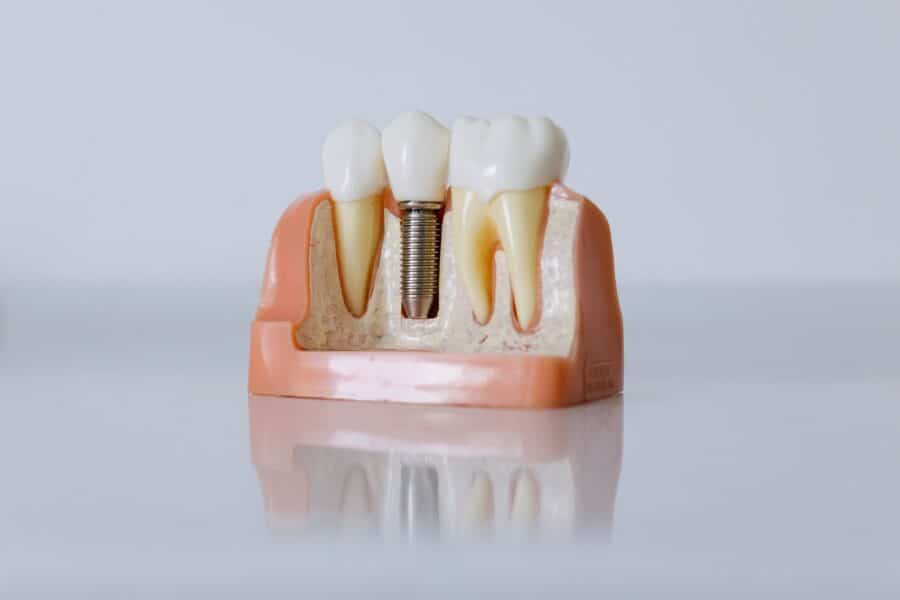 Μόσχευμα Οστού