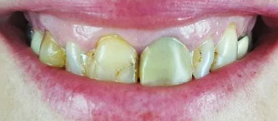 Θήκες Πορσελάνης 2α