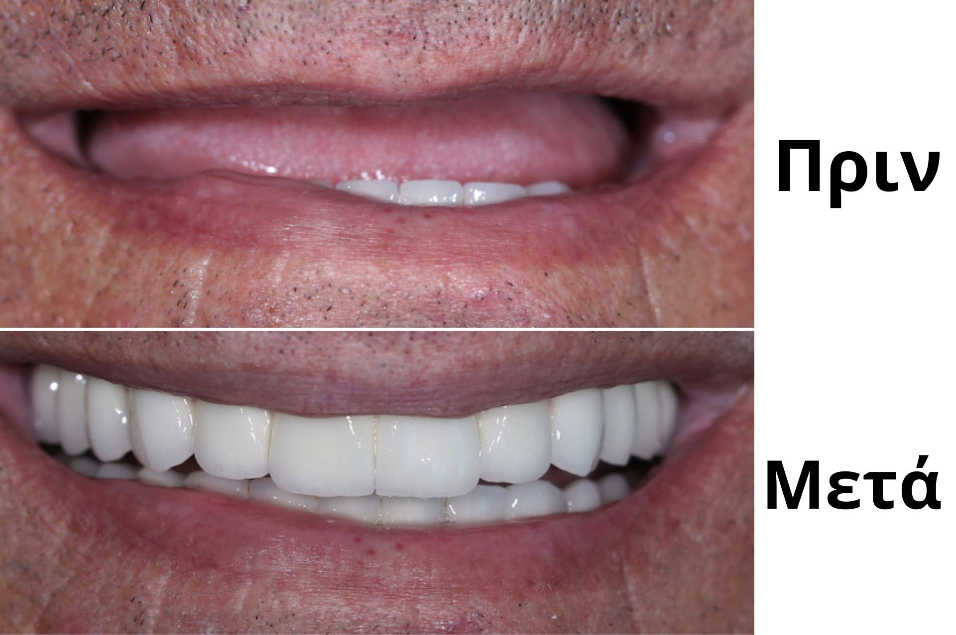 Τοποθέτηση Εμφυτευμάτων Δοντιών 2