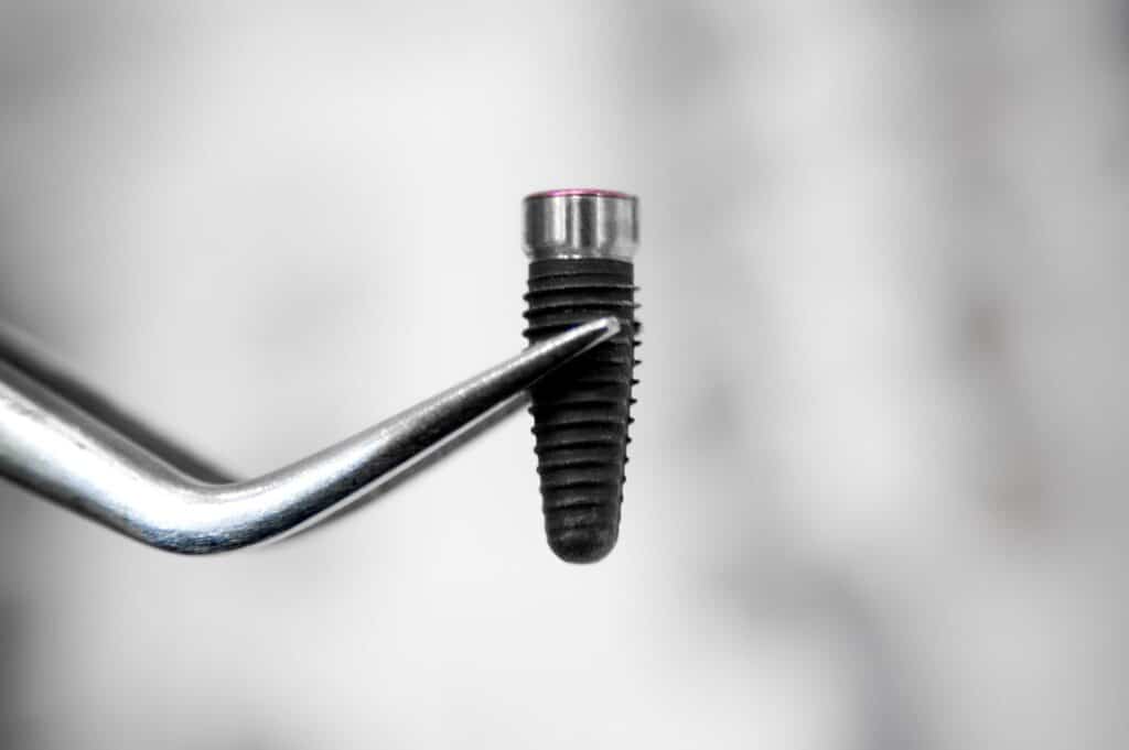 Διαδικασία Τοποθέτησης Οδοντικών Εμφυτευμάτων αποτυχία εμφυτευμάτων δοντιών