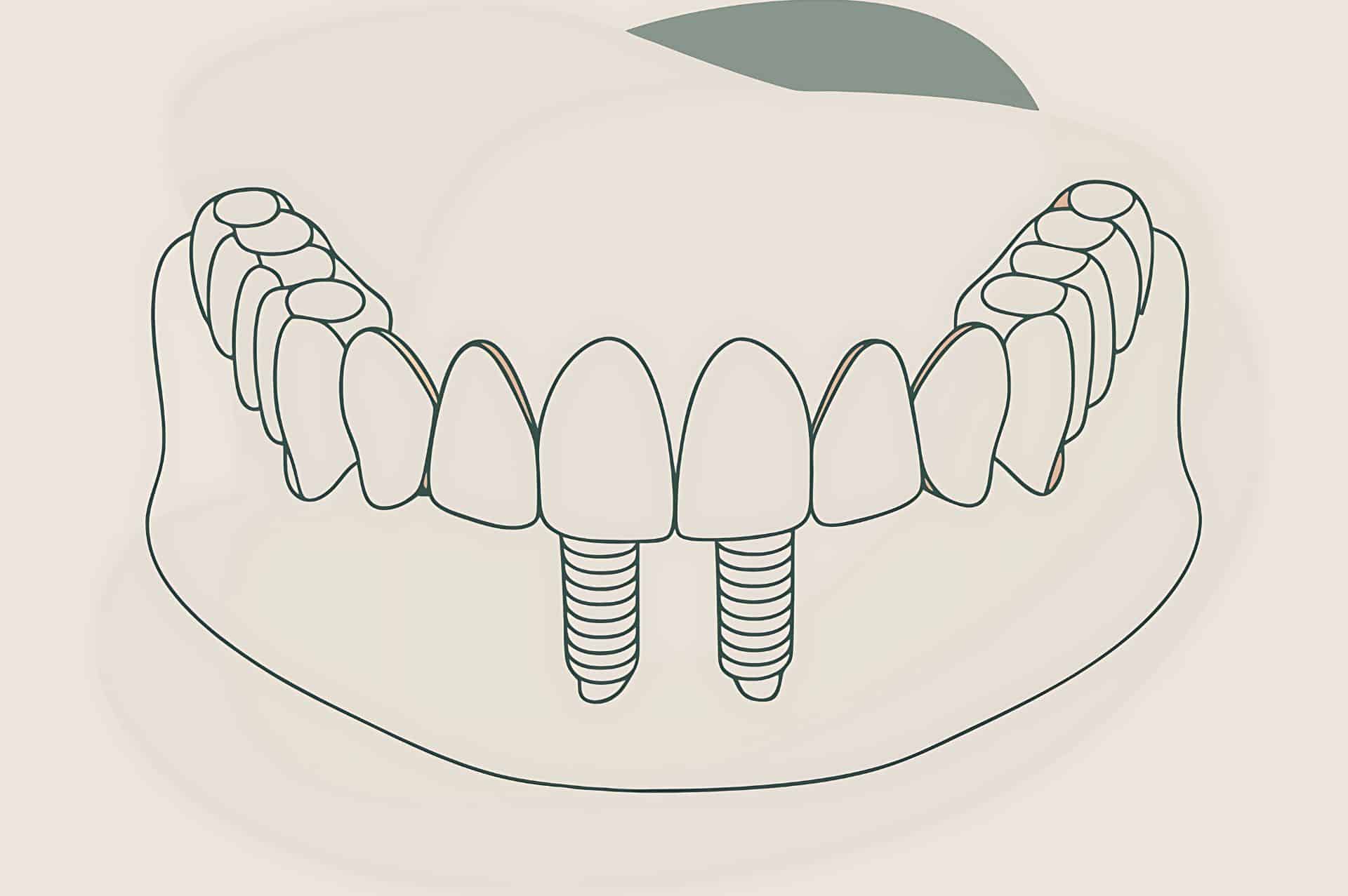 Εξατομικευμένα Εμφυτεύματα Δοντιών – Η Νέα Εποχή στην Εμφυτευματολογία